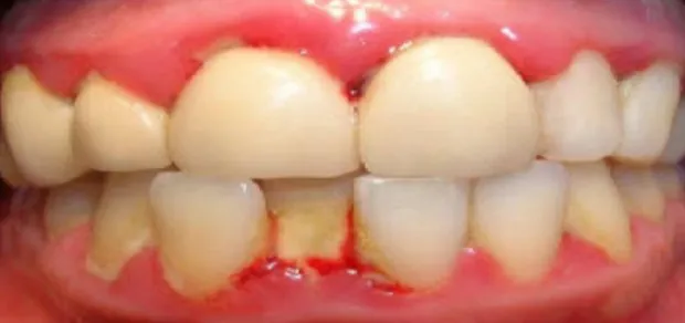 Gambar 2.2 Gambaran klinis gingivitis karena susunan gigi yang tidak teratur Sumber :https://totdental.wordpress.com/sitemap.xml