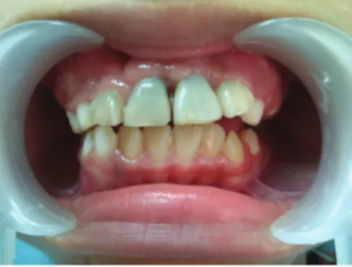 Gambar 5. Perubahan warna pada gigi 11, 21 satu tahun  setelah perawatan
