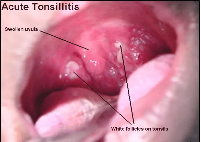 Gambar 2.4 Tonsilitis Akut