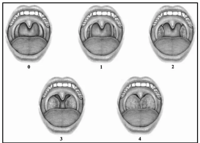 Gambar 2.5 Gradasi Pembesaran Tonsil