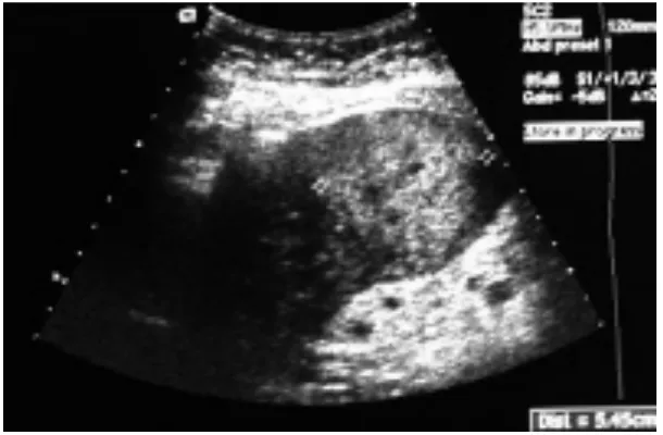 Gambar 2.2  Gambar Ultrasonografi (USG) Abdomen