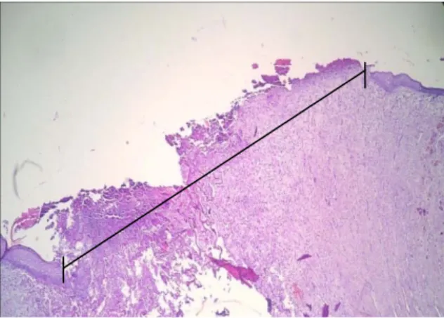 Gambar 7.  Gambaran mikroskopik panjang  luka yang masih terbuka pada luka dengan  pemberian daun binahong.