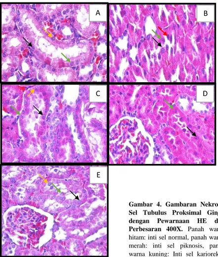 Gambar  4.  Gambaran  Nekrosis  Sel  Tubulus  Proksimal  Ginjal  dengan  Pewarnaan  HE  dan  Perbesaran  400X