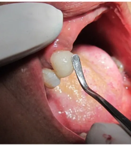 Gambar 2. Foto periapikal gigi 13 setelah perawatan saluran 
