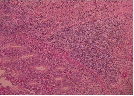 Gambar  2.   Sel –sel radang akut di lapisan mukosa 