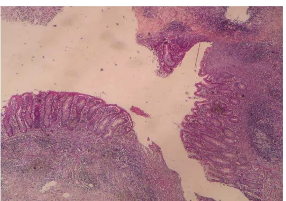 Gambar 5.     Sel –sel radang akut pada seluruh ketebalan dinding apendiks disertai     