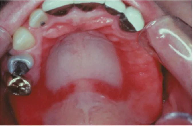 Gambar 1. Denture Stomatitis pada Palatum  Pasien yang Menggunakan Gigi Tiruan  Sebagian Lepasan  5