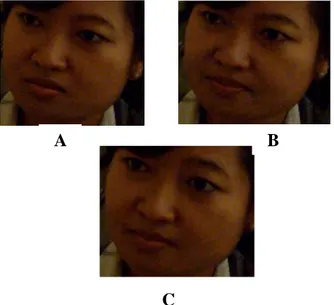 Foto  B  menunjukkan  ekspresi  yang terjadi  ketika  bibir  atas  ditekan  kebawah dan bibir  bawah  ditekan  ke  atas