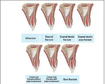 Gambar 1. Kerusakan pada jaringan keras gigi dan pulpa28