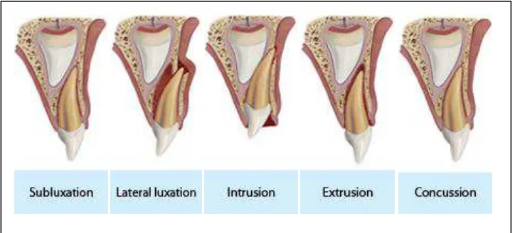 Gambar 2. Kerusakan pada jaringan periodontal28