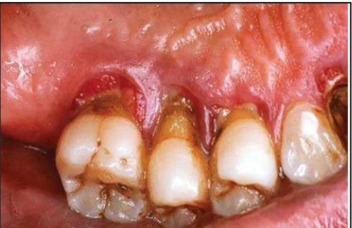 Gambar. Penyakit periodontal pada pasien Diabetes melitus16