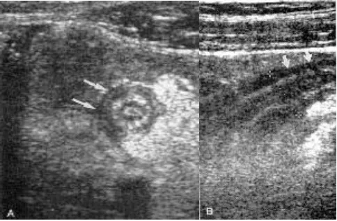 Gambar 3. Gambar USG Appendix normal: A) potongan   transversal;  (B). potonganlongitudinal8