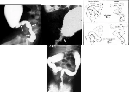 Gambar 5: Beberapa gambaran HD pada pemeriksaan Barium enema:Zone transisi dan spsme (no.2), kontraksi irreguler, mucosa irreguler & bergerigi dan cobblestone