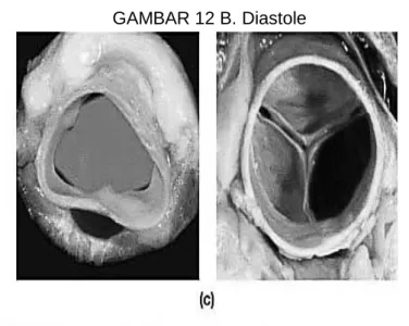 GAMBAR 12 B. Diastole 