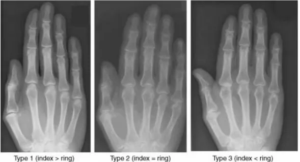 Gambar 2. Tiga kategori (tipe) pengukuran; 1) jari telunjuk lebih panjang daripada jari manis; 2) Jari telunjuk sama panjang dengan jari manis; 3) jari telunjuk lebih