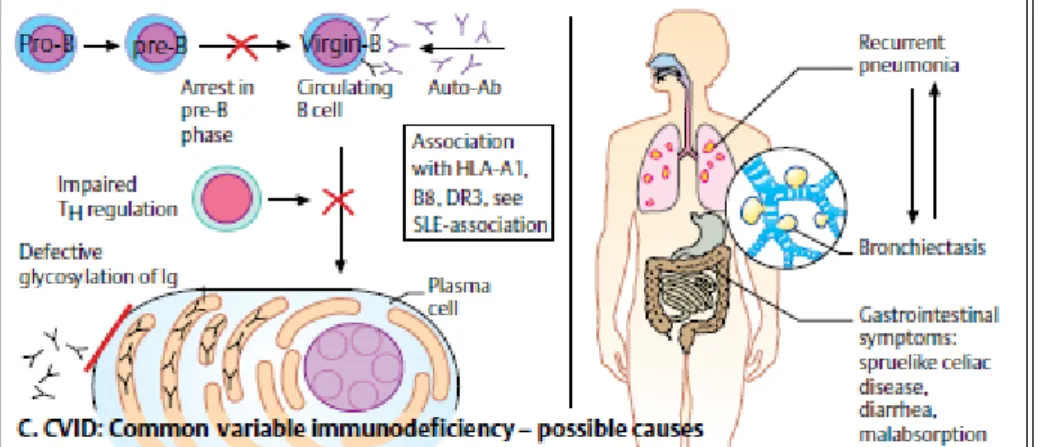 Gambar 5. Common variable immunodeficiency (Gerd  et al., 2003) 