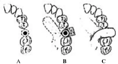 Gambar 3.A: eksisi lingkaran perifer jaringan lunak oroantral fistula, B, de-epitelisasi mukosa palatal daninsisi divergen melalui daerah oroantral, C: pembukaan flap mukoperiosteum, D : pemanjangandan penjahitan flap melewati mukosa palatal yang diepitelisasi.