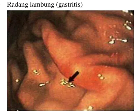 Gambar 2.2 Radang pada dinding lambung 