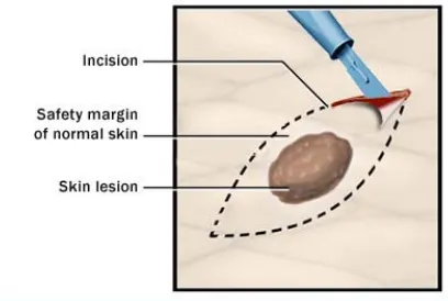 Figure 1. Excisional biopsy.15