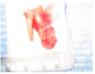 Figure 6. Radicular cyst included the root of the permanentteeth involved.