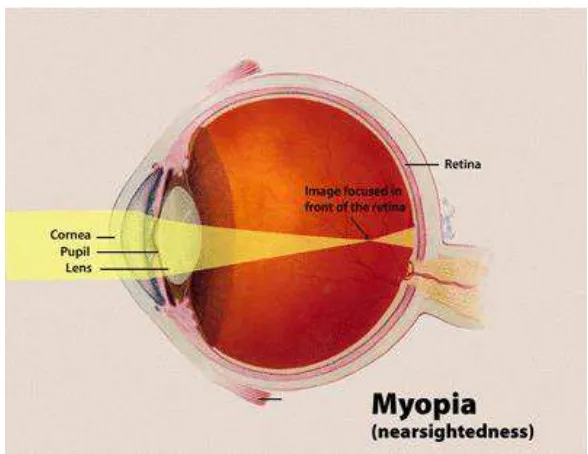 Gambar 2.3 gambaran refraksi miopia 