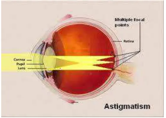 Gambar 2.8  Gambaran refraksi astigmatisma 