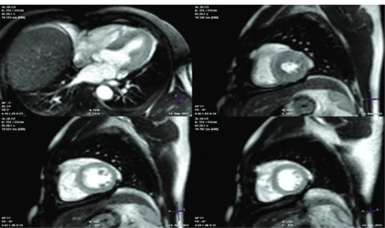 Gambar 3. Pemeriksaan perfusi MRI saat stres tampak hipoperfusi moderat di basal-apikoseptal,  basal-mid lateral
