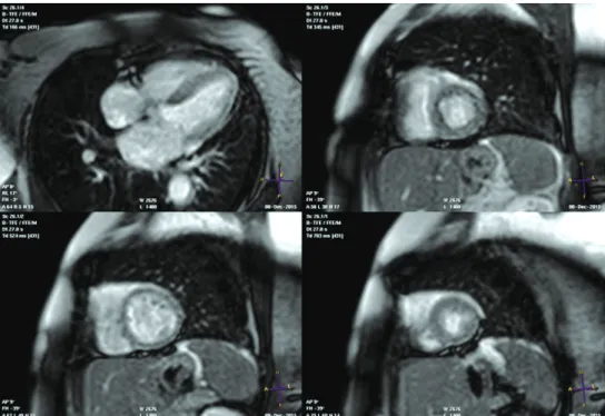 Gambar  7.  Pemeriksaan  perfusi  MRI  saat  stres  memperlihatkan  hipoperfusi  moderat  di  anterior dan septal