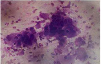 Gambar 2.4 Squamous cell carcinoma, inti polimorfis, khromatin kasar, batas seljelas, sitoplasma kebiruan (Dikutip dari: Lubis M