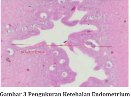 Gambar 2 Pengukuran Ketebalan Endometrium Kelompok II (SOPK) Menggunakan Perbesarran 400 kali dan Diperoleh Hasil 4.212,61 µm 