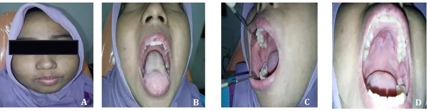 Figure 1  Clinical Features in 19 Years Old Patient at First Visite    A. moon face; B
