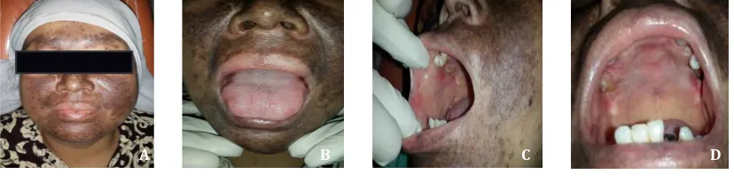 Figure 3  Clinical Feature in Last  Visite    A. moon face; B. tongue; C. ulcer at right buccal mucous; D