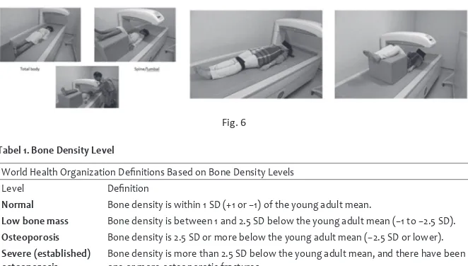Fig. 6Tabel 1. Bone Density Level