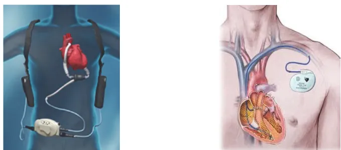 Figure 6: Pictures showing two examples of HR-WPT charging applications in medical devices: Left ventricular assist device (LVAD) (left) and pacemakers (right)