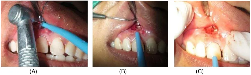 Gambar 1. (A) Terdapat benjolan pada palatal gigi 11 (panah kuning);  (B) terdapat area radiolusen pada apikal gigi 11 (panah kuning) 