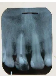 Gambar 7. (A) Foto klinis setelah perawatan selesai menunjukkan mukosa palatal gigi 11 normal (B) Radiograf gigi 11 menunjukkan lesi periapikal berkurang dibanding sebelum tindakan 
