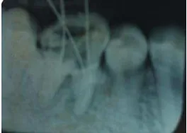 Gambar 3. (A) Pengepasan guta perca tampak klinis. (B) Pengepasan guta perca secara radiografis, tampak sesuai dengan panjang kerja
