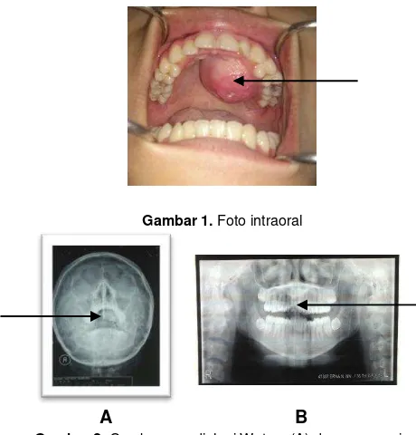 Gambar 2. Gambaran radiologi Waters (A) dan panorami x-ray (B) 