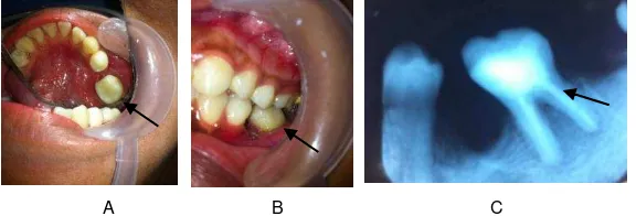Gambar 7 (A) Foto klinis gigi 36 setelah dilakukan restoras, (B) Cek oklusi setelah restorasi, (C) Gambaran radiograf gigi 36 setelah restorasi, tampak adaptasi tepi baik 