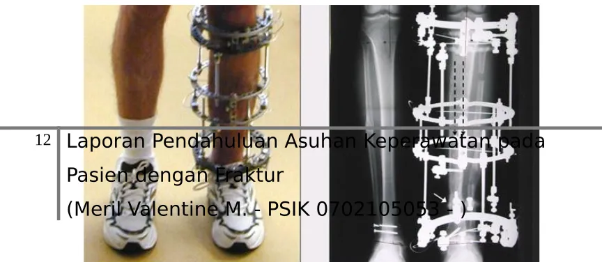 Gambar 2. Fiksasi interna