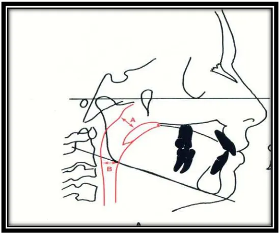Gambar 9. Analisis McNamara : (A) Ukuran lebar saluran udara udarapharynx atas, (B) Ukuran lebar saluran  pharynx bawah 25 