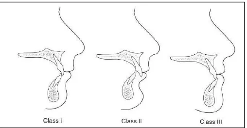 Gambar 1. Klasifikasi maloklusi skeletal.10 
