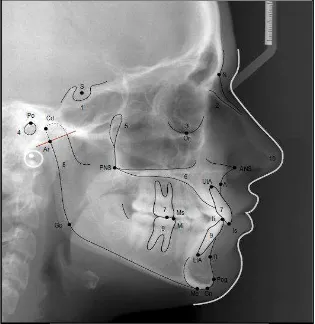 Gambar 3. Titik-titik pada Sefalometri.1 