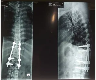 Gambar 1.  Gibbus teraba pada vertebrae 