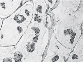 Figure 3. Neuroendocrine carcnoma, (original magnification  ×200)