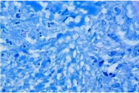 Gambar 2.1. Mycobacterium tuberculosis, dengan pewarnaan Ziehl-Neelsenpembesaran 1000x 21 