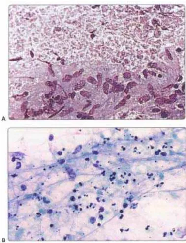 Gambar 2.5. Limfadenitis granulomatosa (tuberkulosis) (A) kaseosa granular Kelompokan seperti granuloma dari histiosit histiosit epiteloid pada latar belakang dari nekrosis (MGG); (B) Material granular dari nekrosis kaseosa dengan inti mengalami degenerati