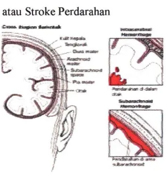 Gambar 2.3. Stroke perdarahan intraserebral dan subarachnoid 