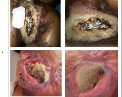 Gambar 6. Luka Kanker Pasien Sebelum dan Sesudah Penggunaan Infus 