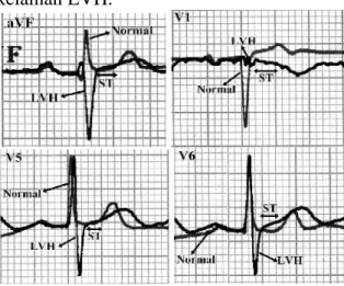 Gambar 19. Perbadingan  hasil rekaman EKG  pasien 1 dan  pasien  3  pada  sadapan  V 6 